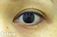 eye_7_w30_s_before