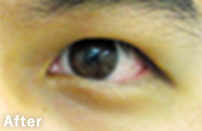 eye_12_m30b_s_after