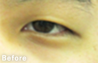 eye_12_m30b_s_before