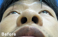 nose_3_m30_s_before