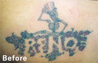 tattoo_2_s_before